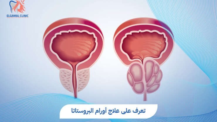 علاج أورام البروستاتا | هل الجراحة ضرورية؟ | د. أحمد عاطف خلاف