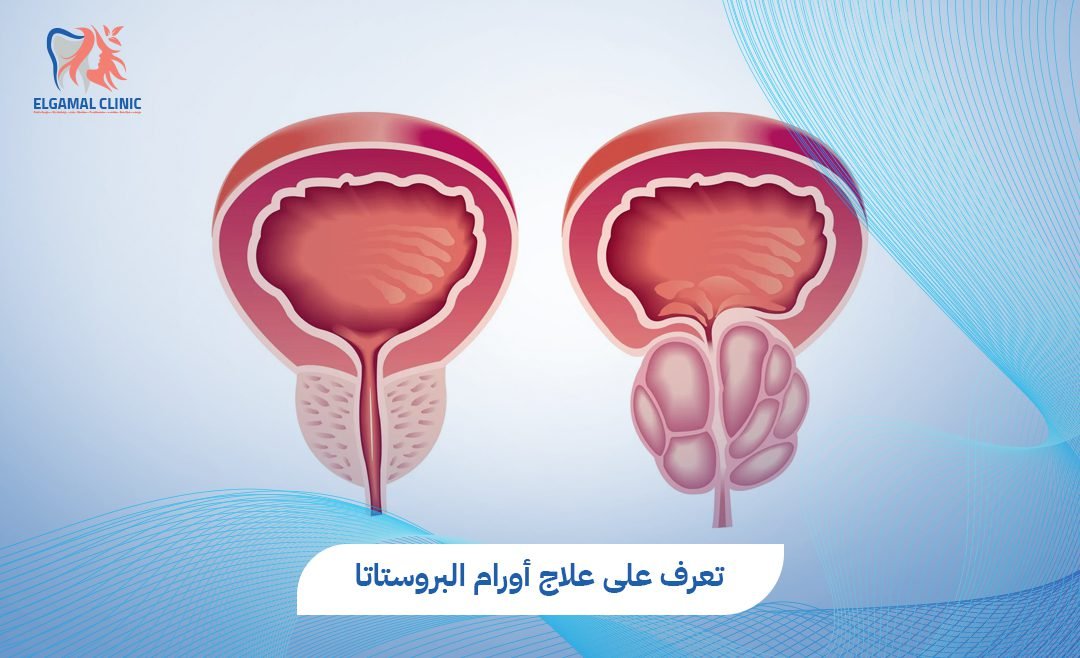 علاج أورام البروستاتا | هل الجراحة ضرورية؟ | د. أحمد عاطف خلاف