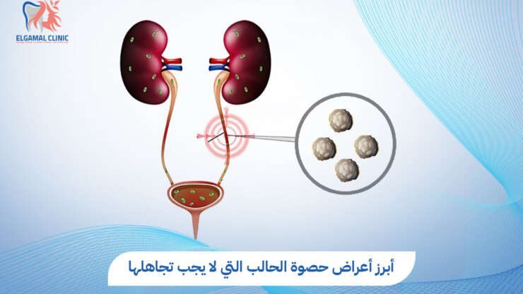 أعراض حصوة الحالب | التشخيص والعلاج بالمنظار والليزر في عيادة الجمل