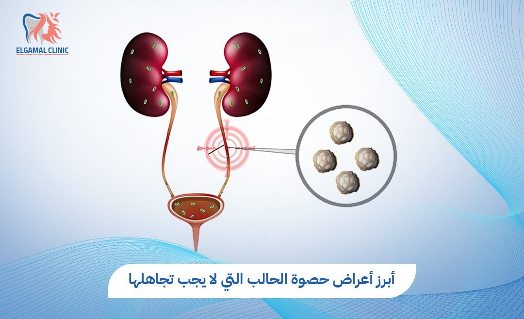 أعراض حصوة الحالب | التشخيص والعلاج بالمنظار والليزر في عيادة الجمل