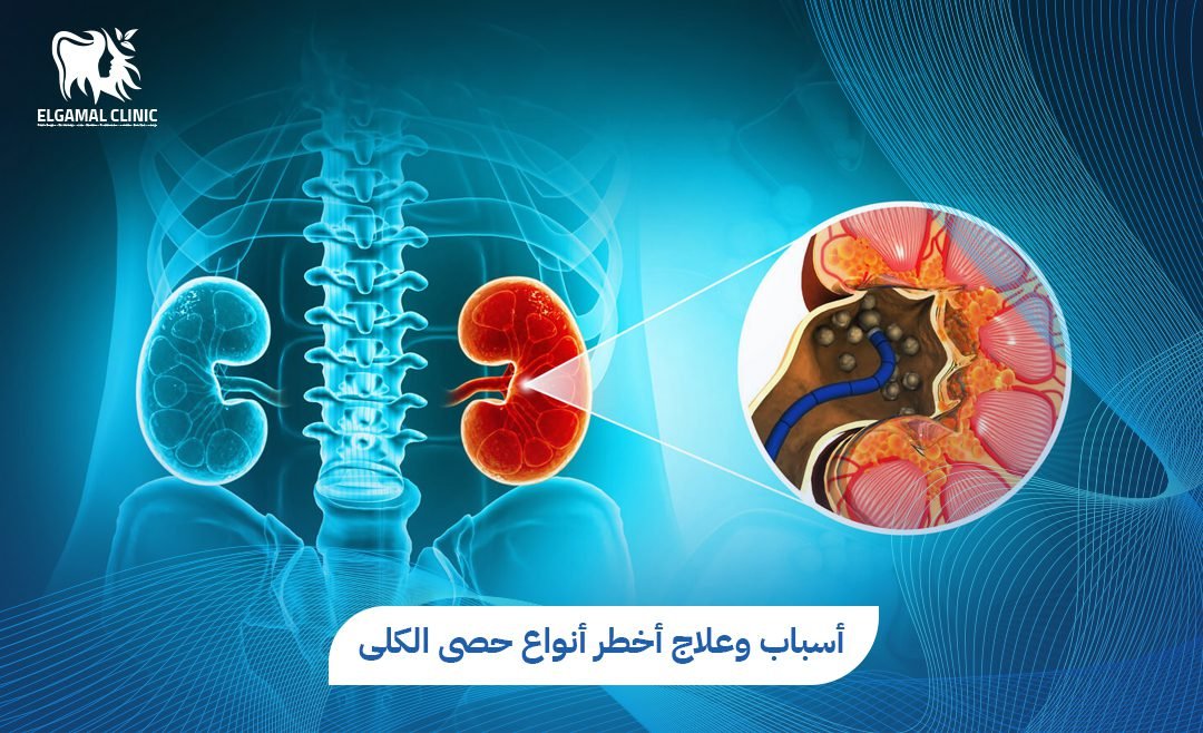 أخطر أنواع حصى الكلى | الأعراض والمضاعفات | عيادة الجمل