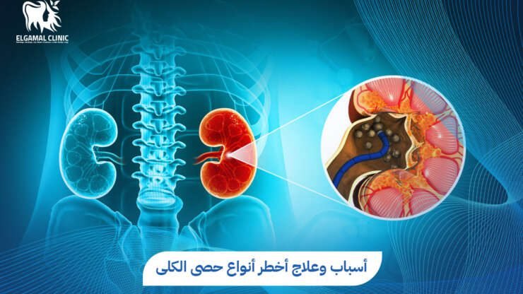 أقوى علاج لتفتيت حصى الكلى | الدكتور أحمد عاطف خلاف