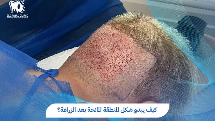 شكل المنطقة المانحة بعد الزراعة 2026 | د. أحمد لطفي الجمل