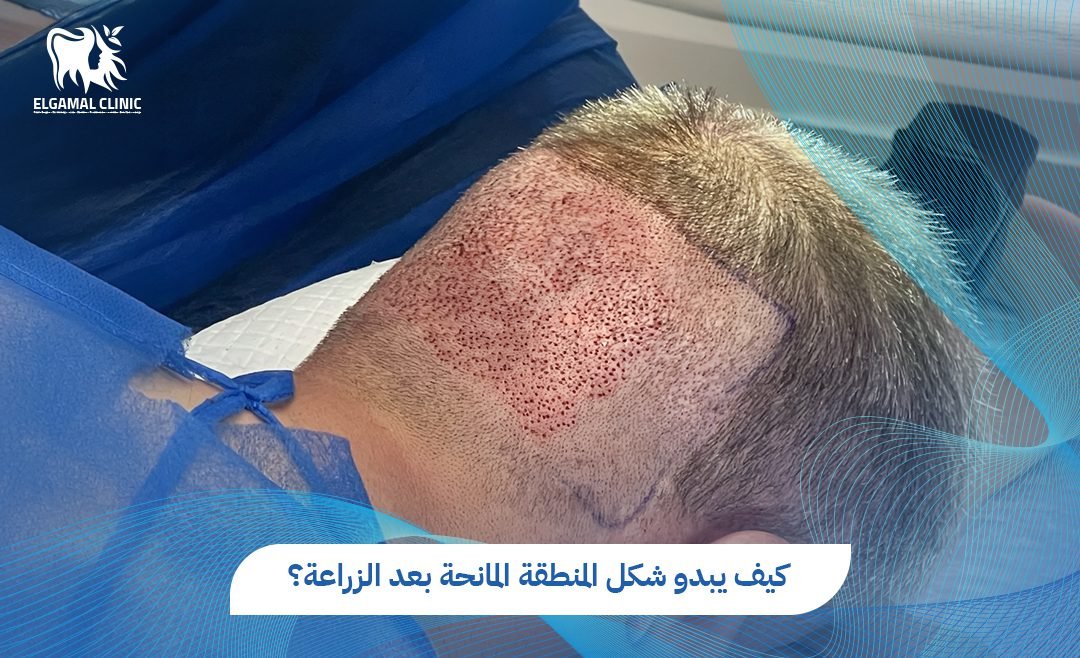 شكل المنطقة المانحة بعد الزراعة 2026 | د. أحمد لطفي الجمل