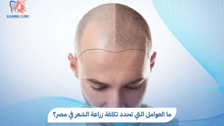 تكلفة زراعة الشعر في مصر 2026 | د. أحمد لطفي الجمل