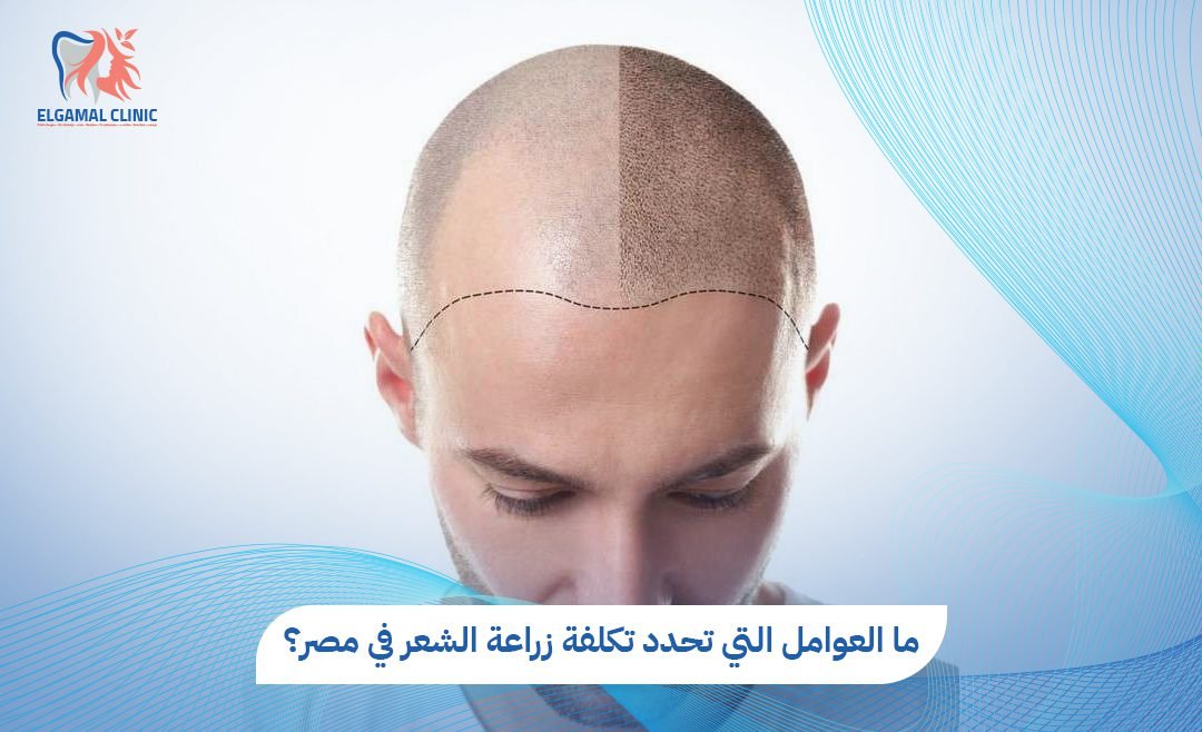 تكلفة زراعة الشعر في مصر 2026 | د. أحمد لطفي الجمل