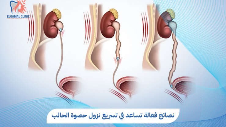 تسريع نزول حصوة الحالب | أسرع طرق العلاج | عيادة الجمل