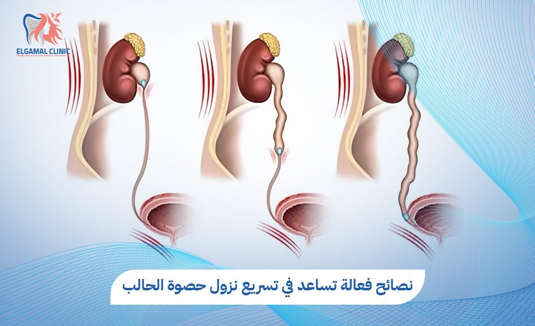 تسريع نزول حصوة الحالب | أسرع طرق العلاج | عيادة الجمل