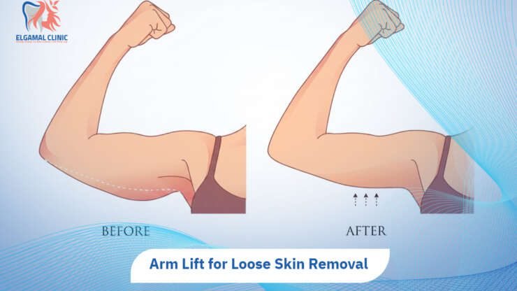 Arm Lift Surgery | Recovery, Cost, Scars & Results 2026