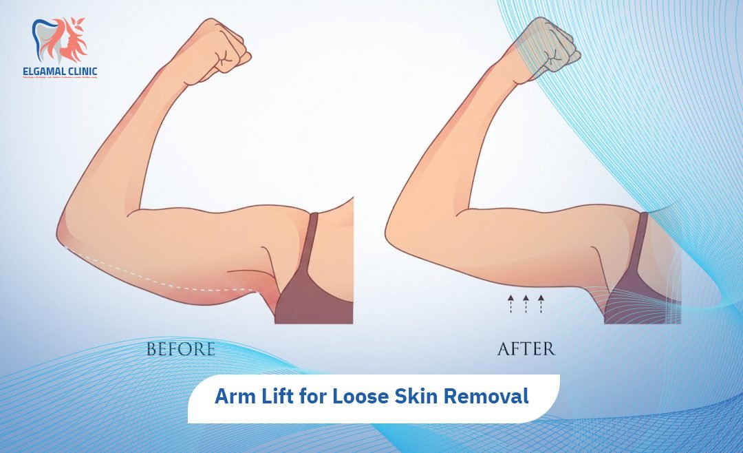 Arm Lift Surgery | Recovery, Cost, Scars & Results 2026