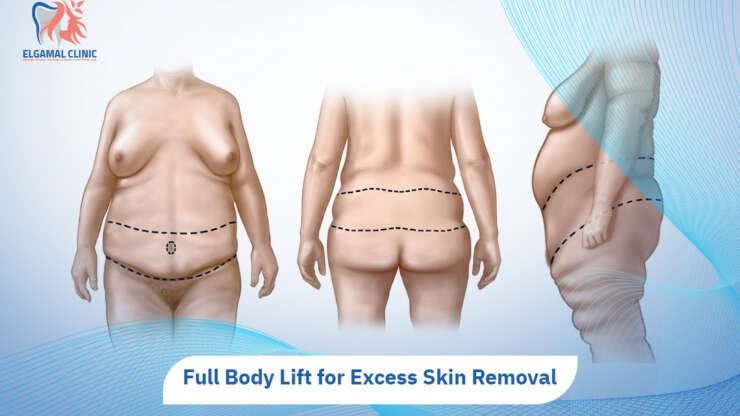 Full Body Lift Surgery 2026 | El Gamal Clinic