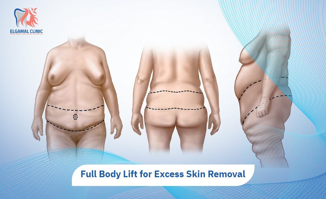 Full Body Lift Surgery 2026 | El Gamal Clinic