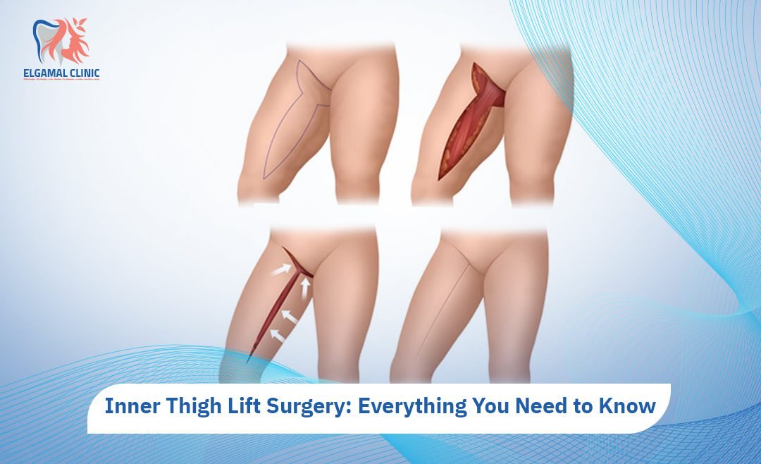 Best Inner Thigh Lift Surgery in Cairo | El Gamal Clinic
