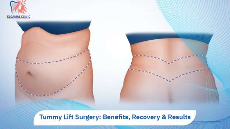 Tummy Lift Surgery | Dr Ahmed Lotfy El Gamal