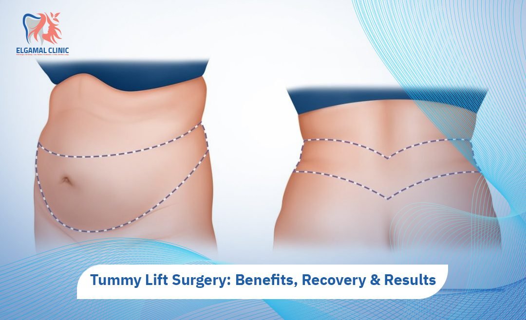 Tummy Lift Surgery | Dr Ahmed Lotfy El Gamal