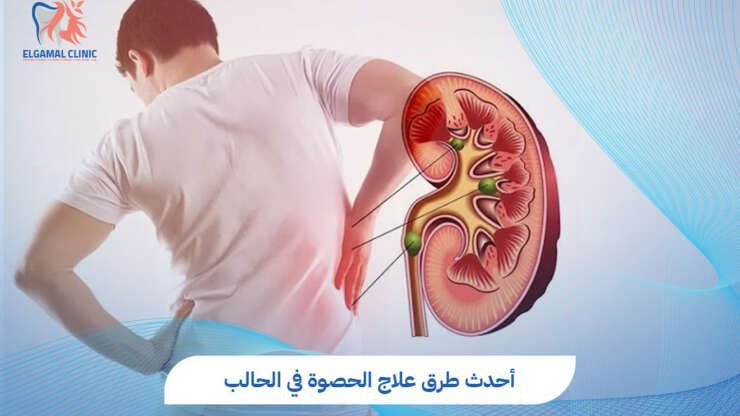 أحدث طرق علاج الحصوة في الحالب | عيادات الجمل