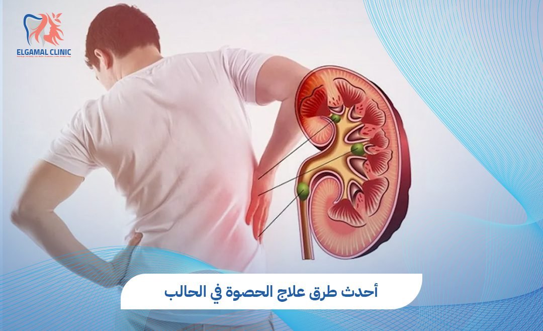 أحدث طرق علاج الحصوة في الحالب | عيادات الجمل