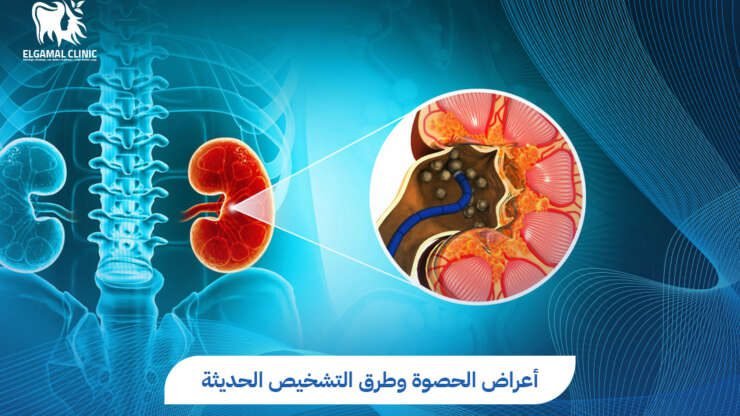 أعراض الحصوة وطرق التشخيص السريع | عيادات الجمل