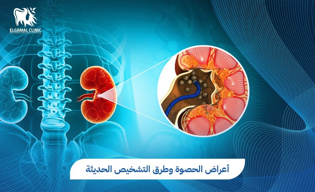 أعراض الحصوة وطرق التشخيص السريع | عيادات الجمل