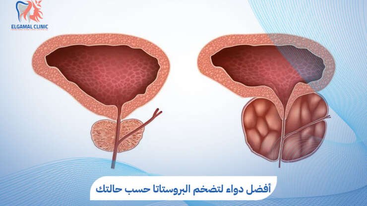 أفضل دواء لتضخم البروستاتا | الأنواع والآثار الجانبية | دكتور أحمد خلاف