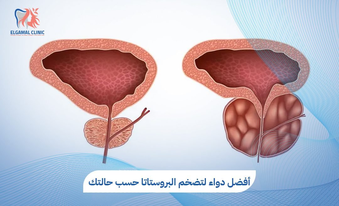 أفضل دواء لتضخم البروستاتا | الأنواع والآثار الجانبية | دكتور أحمد خلاف