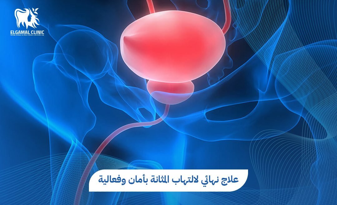 علاج التهاب المثانة في 5 خطوات | عيادات الجمل