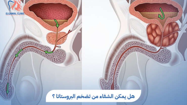 هل يمكن الشفاء من تضخم البروستاتا؟ | عيادة الجمل
