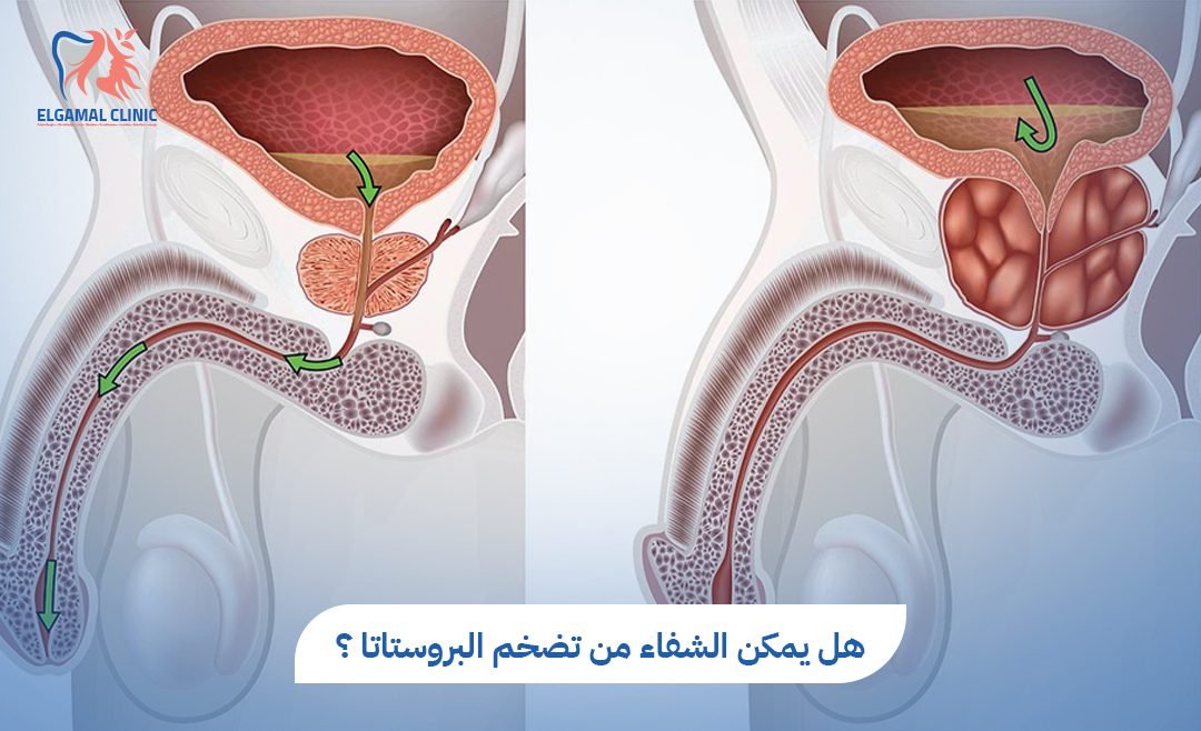 هل يمكن الشفاء من تضخم البروستاتا؟ | عيادة الجمل