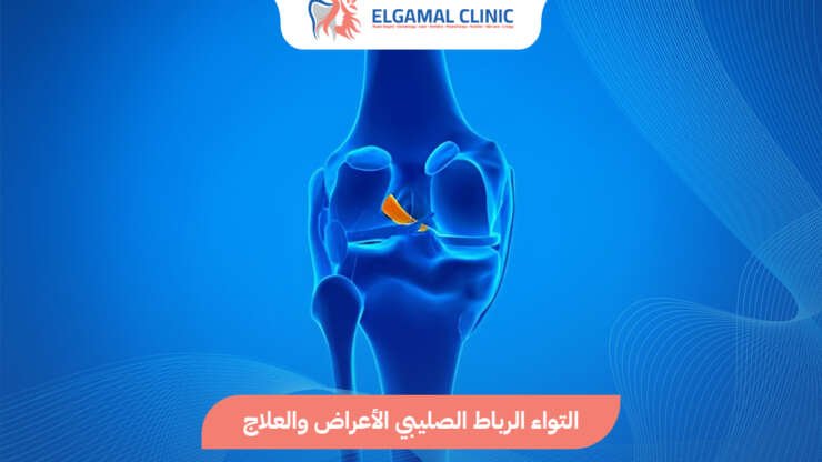 التواء الرباط الصليبي: الأعراض والعلاج والتأهيل | عيادة الجمل