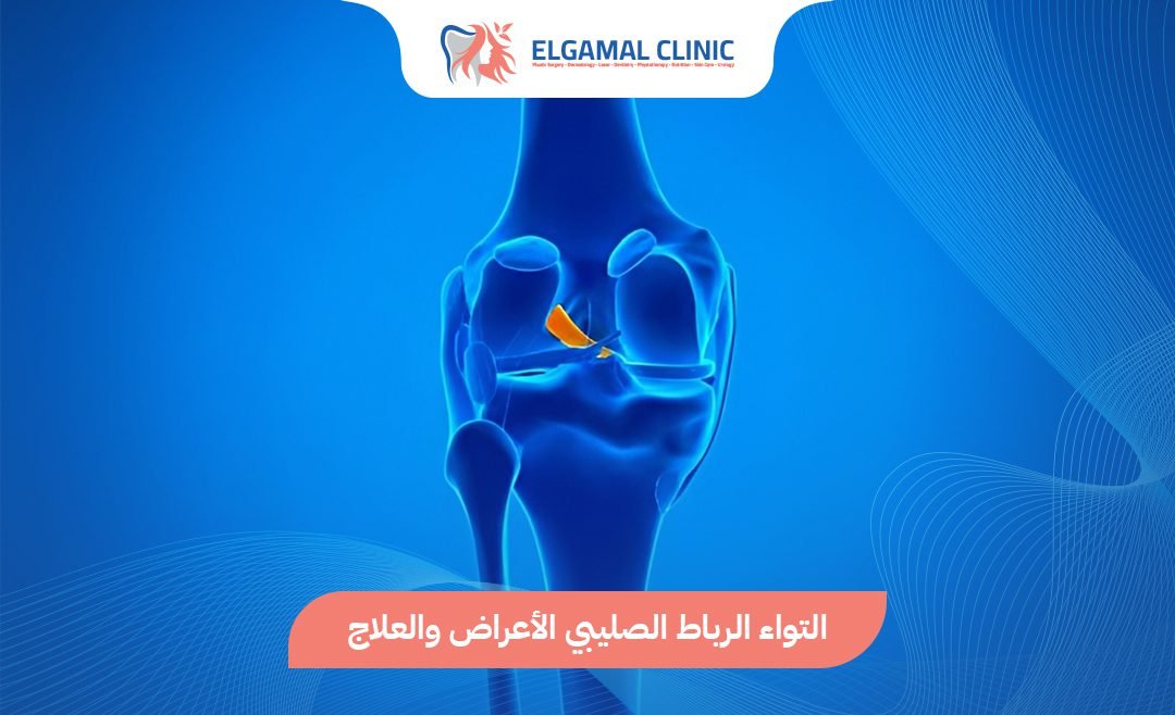 التواء الرباط الصليبي: الأعراض والعلاج والتأهيل | عيادة الجمل